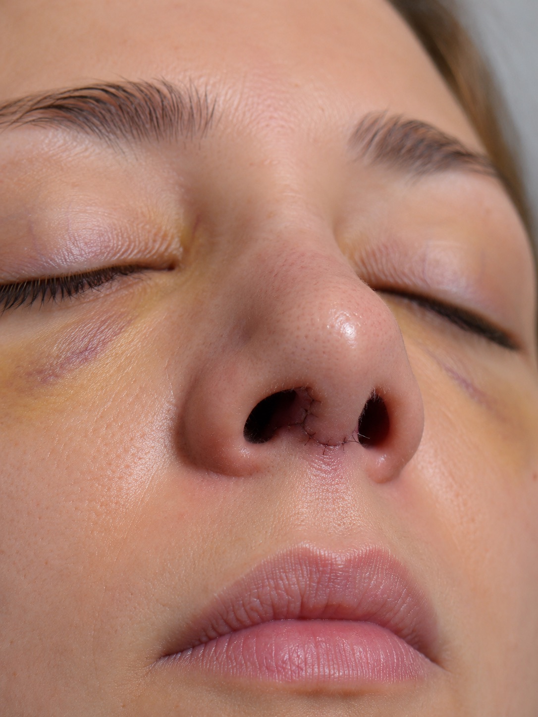 Foto de cicatrización tras rinoplastia enviada por el paciente en un control estructurado